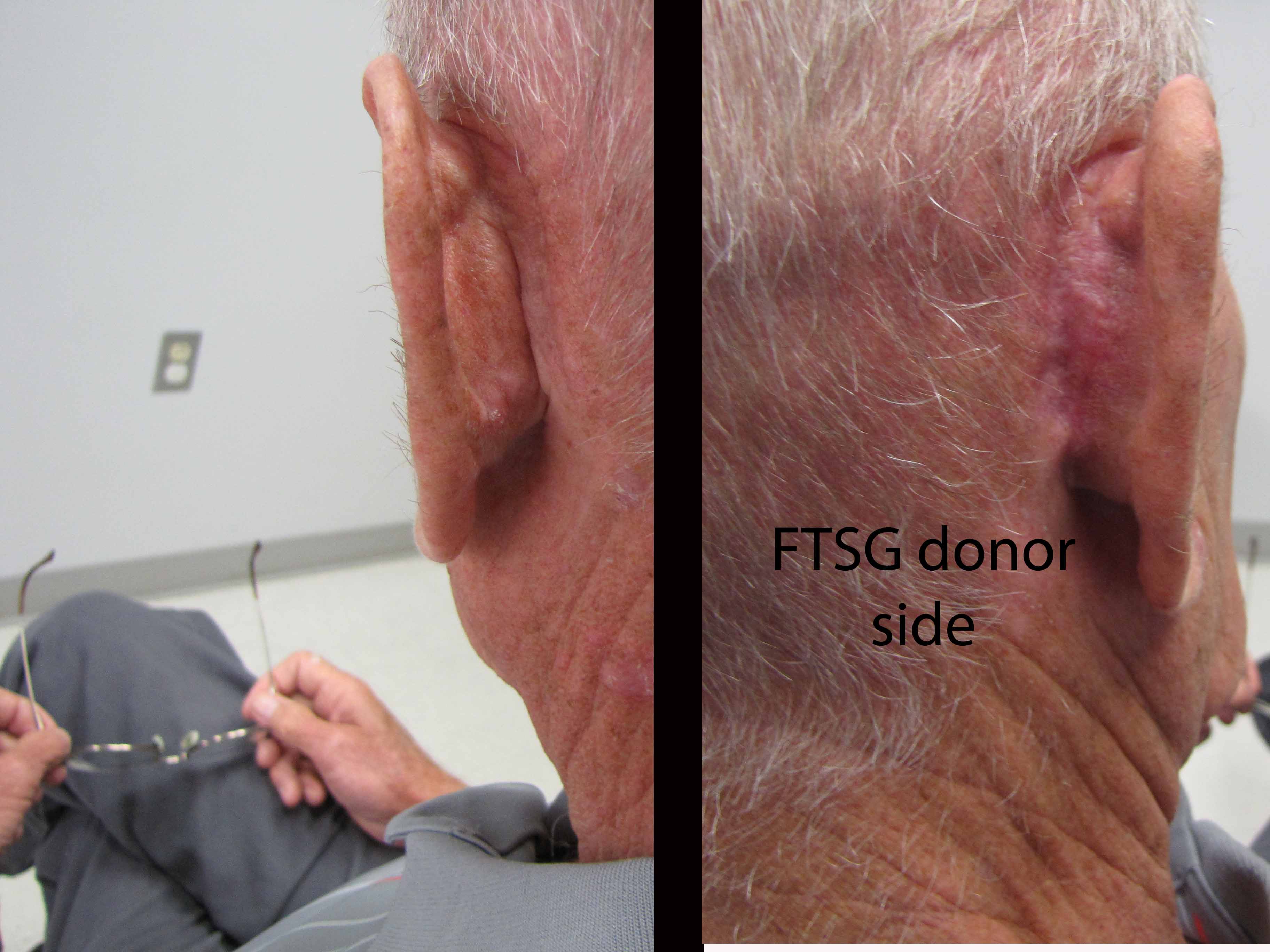 Case Example Full Thickness Skin Graft Iowa Head and Neck Protocols